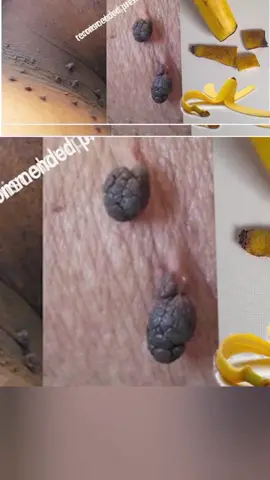 Remove skin tags at home completely in 3 days with Banana peel!! skin tag removal natural remedies! #skintok #skincaretips #skincareroutine #skintags #skintagsremoval #removeskintags #howtoremoveskintags #Recipe #tags #tagsomeone #fyp #fypシ゚viral #trending 