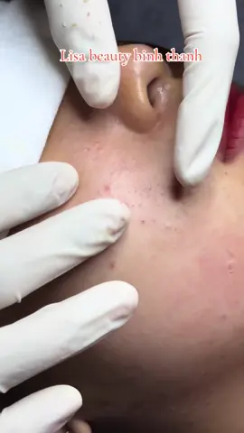Nặn mụn . Lisa beauty binh thanh#LisaBeauty #nanmunchuanykhoa #Chămsócda #Điềutrịdakhoahọc #hocnghespa #dieutrimun 
