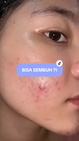 moist gel ringan tapi tetep menghidrasi nampol + sembuhin kemerahan luamayan cepet 🫶🏻 #acneskin #acnetreatment #skincaretips #moisturizer #acneproneskin #fakesituation⚠️ #fakebodyy⚠️ 
