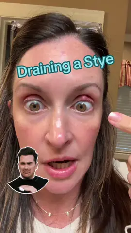 This thing had its own zip code until I got the prescription from the dr, but this heated rolling thing is getting that gunk GONE. #stye #styeeye #styerelief #chalazion #ocularrosacea 