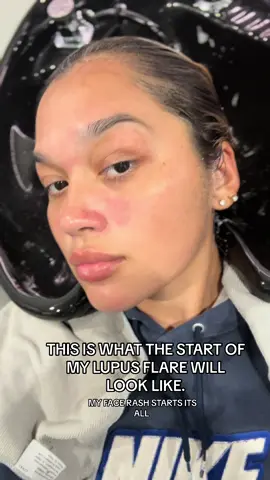 Im always asked how do I know im about to start a flare , well my rash tells me everything I need to know….. 😬 #lupus #lupusawareness #autoimmunedisease #lupuswarrior #butterflyrash #rash #lupus 