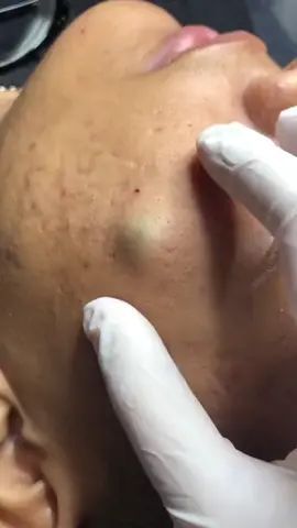#fy #pimple #tiktok #asmr #fofoca #polemica #pimpleremover #espinhas #cravo #blackhead 