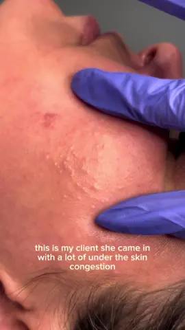 Treating non inflamed acne on my client #extraction #extractionsatisfaciton #estheticianlife 