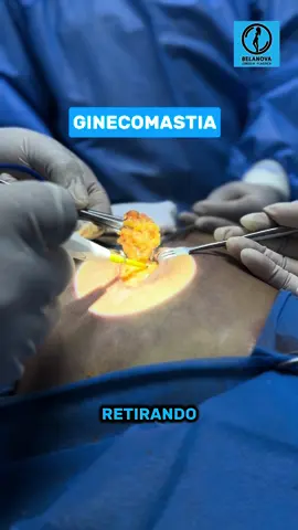 Ginecomastia 