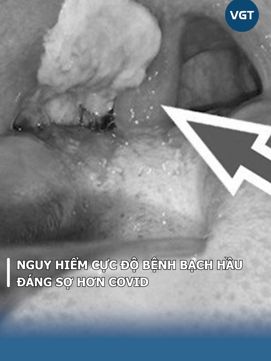 Nguy hiểm cực độ bệnh bạch hầu, đáng sợ hơn Covid#benhbachhau#bachhau#benhtruyennhiem#tinnong#hottrend#tinnhanh#thegioikythu#vgttv