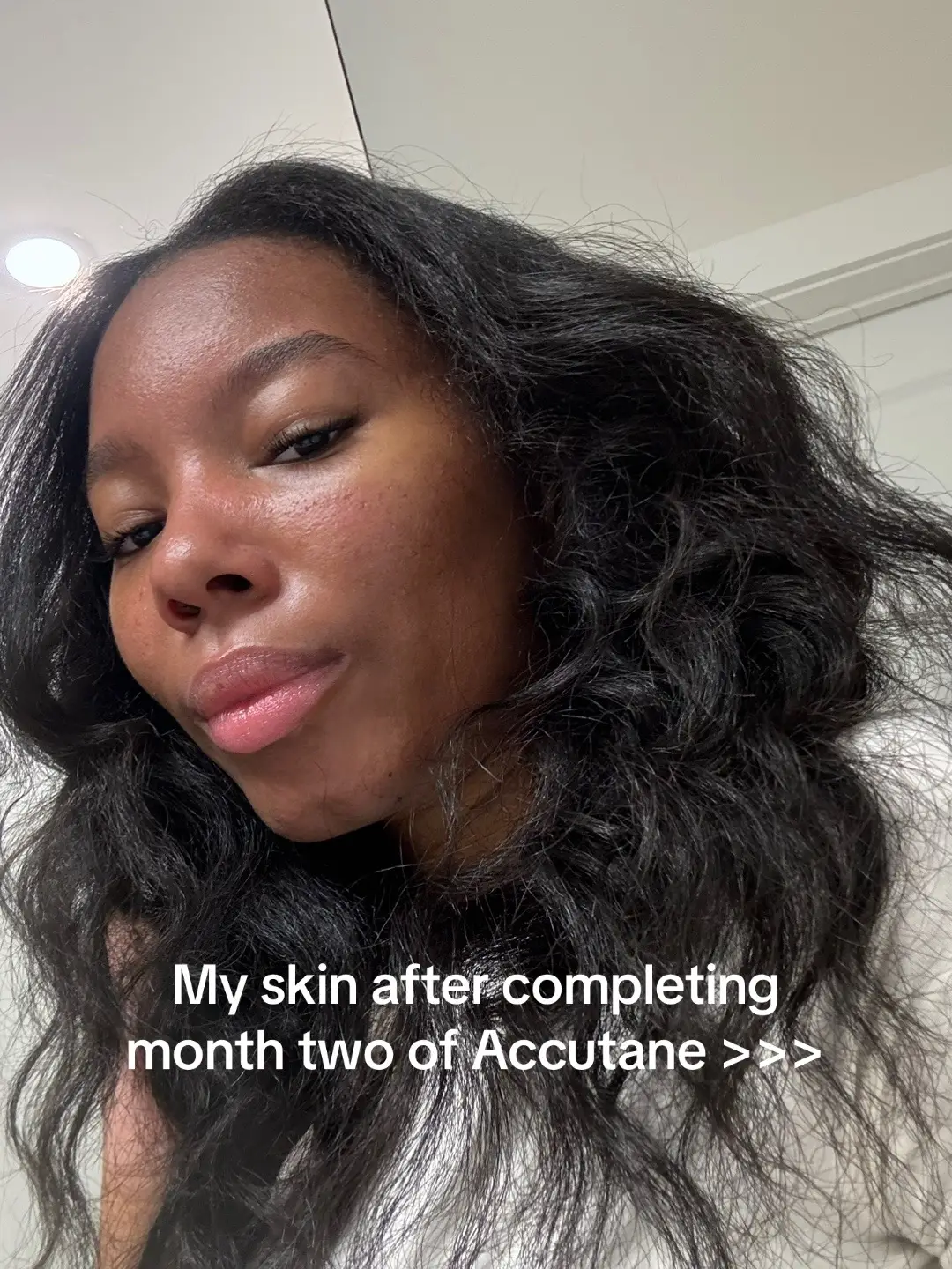 Permanently curing my acne through Accutane. I’m loving the progress! #acnetreatment #acne #accutanejourney #accutanecheck 