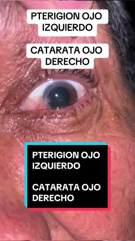 PTERIGION OJO IZQUIERDO CATARATA OJO DERECHO #oftalmologia #medicina #Cochabamba #Bolivia #cirugia #retinaspecialist #diagnostico 