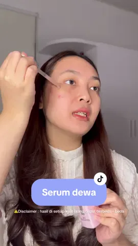 Ternyata lebih dewa ini yaa dibanding vit c dan niacinamide ✨✨ aku lebih cocok pake serum melasyl ini ternyata 🫶🏻🫶🏻 #LorealParisID #GameOverNodaHitam #Melasyl #skin #Niacinamide #GlycolicAcid #BekasJerawat #Brightening #Serum #stitch @L'Oreal Paris Indonesia  