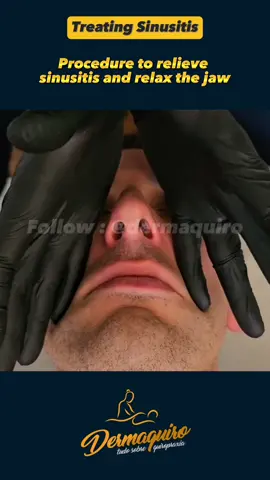 Sinusitis is an inflammation or swelling of the tissue lining the sinuses. Healthy sinuses are filled with air, but when they become blocked and filled with fluid, germs can grow and cause an infection. #chiropractor #chiropractic 