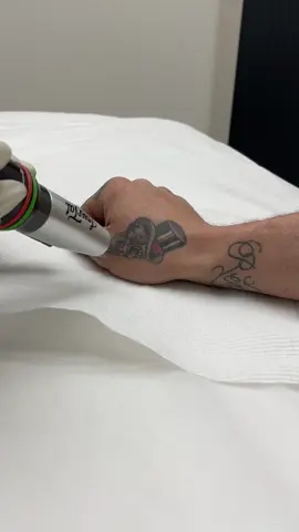 Hats off to this client for sitting so well during his first treatment! 🎩 See how quick a treatment can be! 💥 If the fear of pain has been holding you back, knowing it will be over in a flash (literally!) can make laser tattoo removal treatments so much more bearable. ⚡️ DM us or head to our website for bookings 💻 #lasertat #lasertattooremoval #tattooremoval #tattoos 