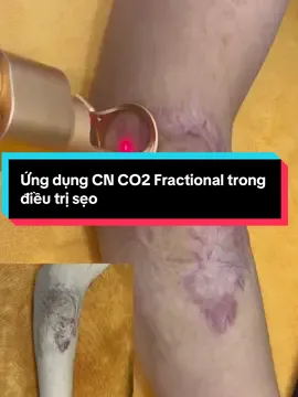 Công nghệ Laser CO2 Fractional sử dụng tia Laser CO2 có bước sóng 10.600 nm tác động sâu vào lớp hạ bì để tái tạo da, điều trị sẹo rỗ, sẹo lõm, đặc biệt các sẹo rỗ sâu và lâu năm. Đây là kỹ thuật trẻ hóa da tiên tiến, được các nhà khoa học phát triển nhằm khắc phục những nhược điểm của Laser CO2 truyền thống #depcungsohee #dalieuthammy #dieutriseo #co2fractionallasertreatment 