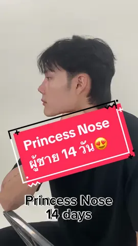 จมูก Princess Nose เพียง 14 วัน หล่ออปป้า ชาอึนอูมาก 🫶🏻💓 #โรงพยาบาลเลอลักษณ์ #ศัลยกรรม #รีวิวบิวตี้ #เสริมจมูก #จมูกทรงเกาหลี #prinessnose #จมูกใหม่ #ทำจมูก #fever #tiktok #enhypen 