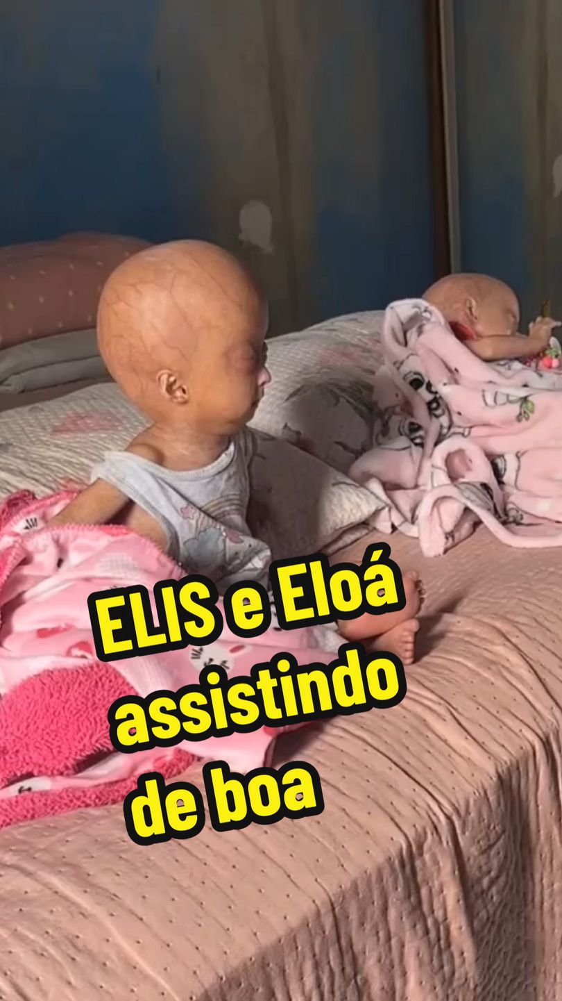 #gemeasidenticas #sindomedavelhice #progeria #progeriaresearchfoundation #sindromerara #eliseeloa #eloaeelis 