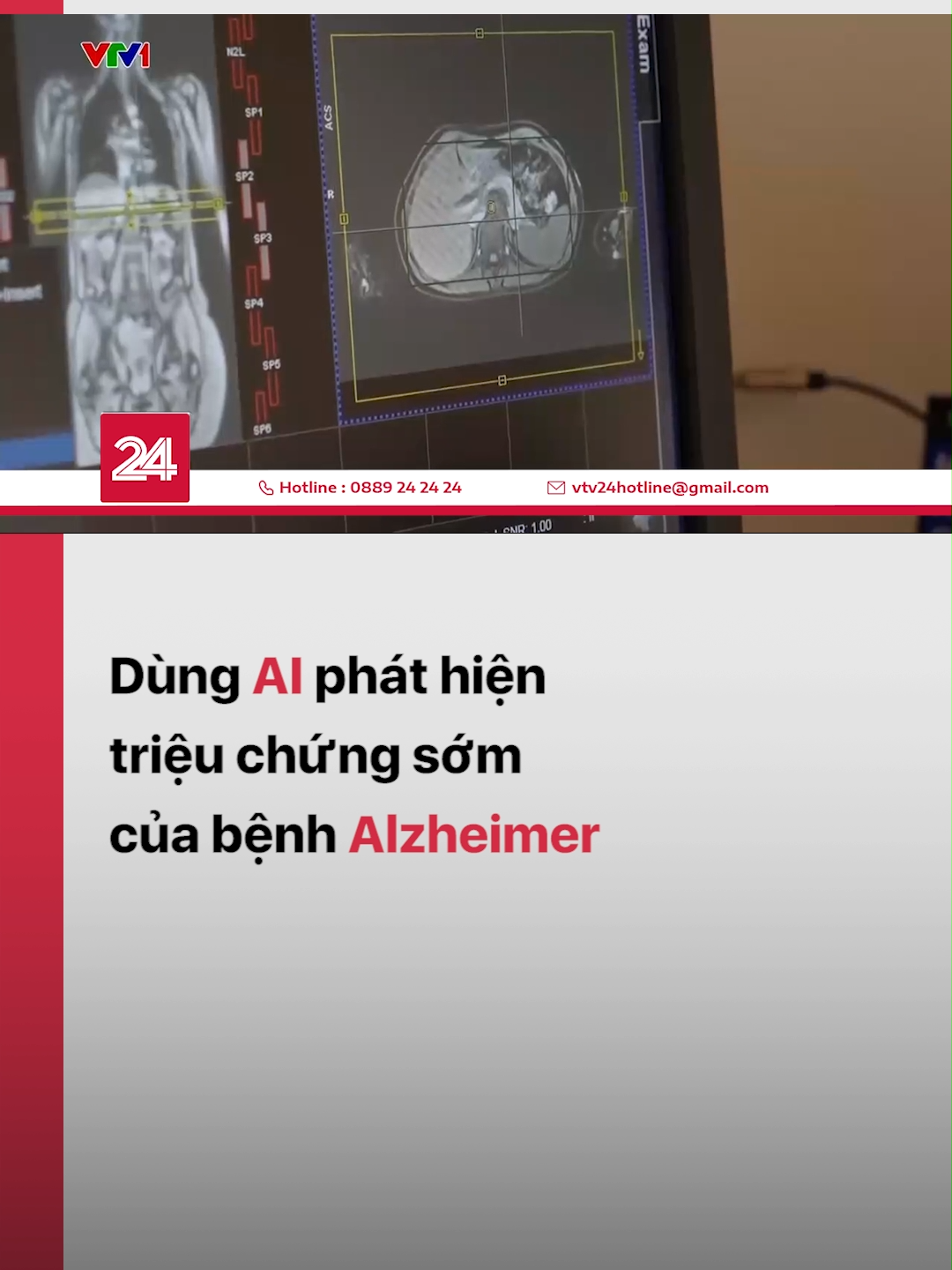 Tại Anh, các nhà nghiên cứu đã phát triển A.I có thể phát hiện triệu chứng sớm của bệnh Alzheimer #vtv24 #vtvdigital #tiktoknews #trituenhantao #alzheimer