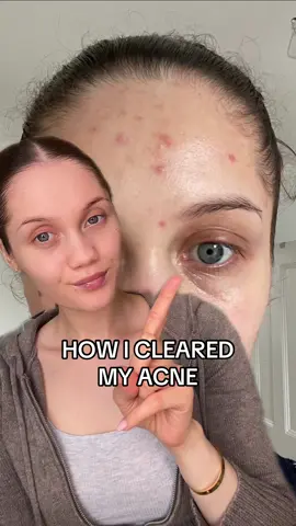 Top things I did and continue to do to clear my acne #tretinoin #azelaicacid #acnejourney #skincareroutine #acnetips #skincaretips #oilyskin #cloggedpores 