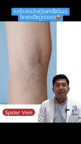Telegram: 096 9999 563 -          Spider vein.              #medicalstudental #doctor #medicine #drboun #ICU #reanimation #varicoseveins #vascularultrasound #vasculardisease #footulcer 