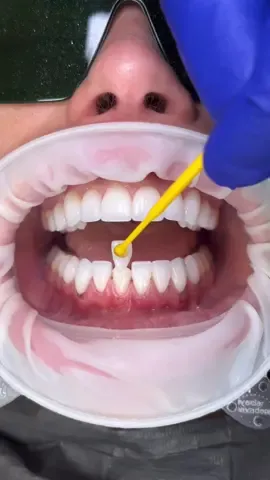 Adding lower porcelain veneers to complete smile makeover ✨ #veneers #bottomveneers #lowerveneers #bottomteethtalker #porcelainveneers 