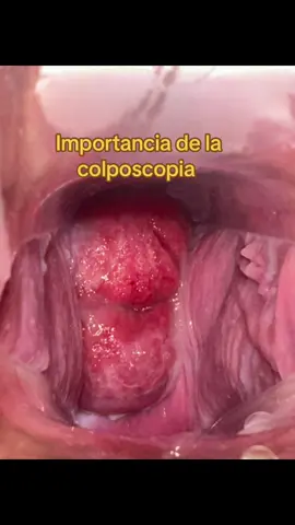 #cuellopatologico #vph #cancer #colposcopia #pap acude a tu CONTROLGINECOLOGICO manos especializadas #ginecologia #bolivarmedic #draraulyeris #medicosvenezolanosenperu 