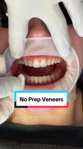 No prep veneers. Prepless veneers #veneers #noshaveveneers #preplessveneers 