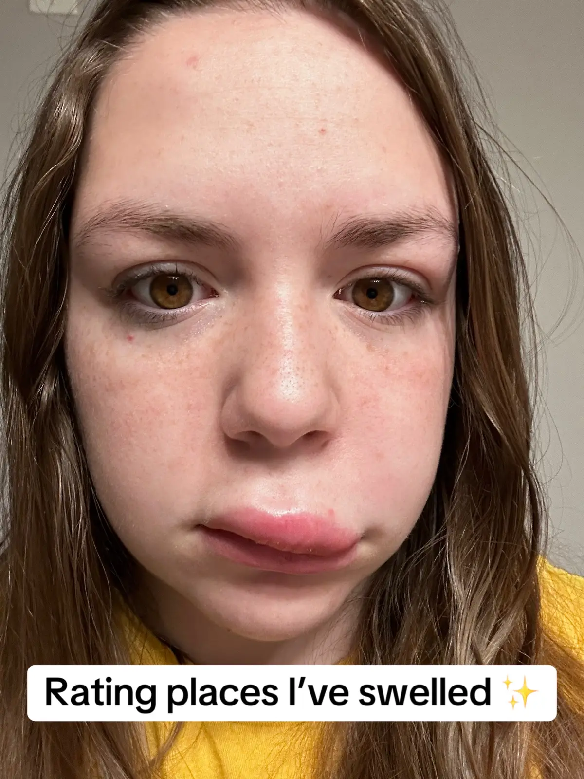 #fyp #foryoupage #foryou #fyppppppppppppppppppppppp #fy #swelling #angioedema #fypage #fypageシ #medical #doctor #tiktok