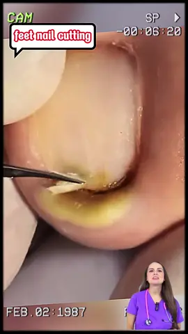 #cutrottennail #podologia #toenail #cleaningtoenail #cutrottennail 