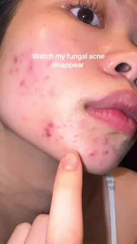 #malasseziafolliculitis #fungalacne 