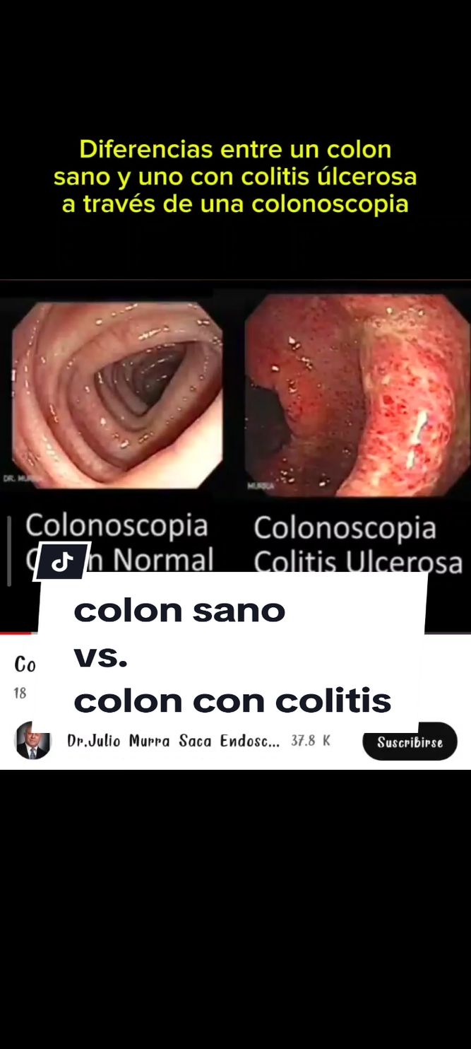 las diferencias entre un colon sano y un colon con colitis ulcerosa son marcadas y visibles durante el procedimiento. Un colon sano presenta una mucosa lisa, de color rosado y sin inflamación ni lesiones visibles. En cambio, un colon con colitis ulcerosa muestra signos claros de inflamación, como enrojecimiento, ulceraciones, sangrado, y pérdida de la estructura normal de la mucosa. Estas características inflamatorias suelen estar localizadas en el recto y pueden extenderse a lo largo del colon, afectando su función y causando síntomas como diarrea, dolor abdominal y sangrado rectal. #Colonoscopia #ColitisUlcerosa #SaludIntestinal #Gastroenterología #ColonSano #InflamaciónIntestinal #DiagnósticoColitis #MucosaIntestinal #SaludDigestiva #EnfermedadesIntestinales #BienestarIntestinal #PrevenciónColitis #SaludGastrointestinal #TratamientoColitis #CuidadoIntestinal #byebyecolitis #colitis #cuci #colitisulcerosa #colitisulcerativa 