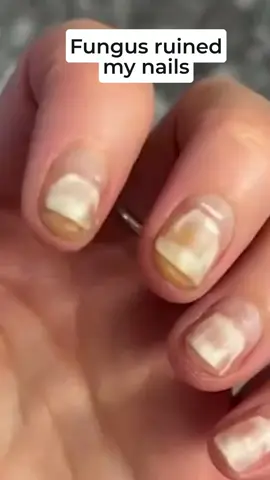 Cure nail infections naturally! 🌿✨ Use this herbal spray for safe, quick results. #nailfungus #toenail #nailfungustreatment #footfungus #fungalinfection #footfungus #nailrepair #nailproblem #infectednail #fungusremover #healthynails #plantbased #vegan #SelfCare #healthylifestyle #welness #beauty #crueltyfree #dermatologist 