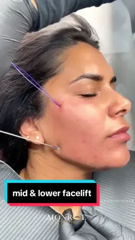 #pdothreads #pdothreadlift #threadlift #facelift #midfacelift #lowerfacelift #pdothreadslondon #threadliftlondon #aestheticstraining 
