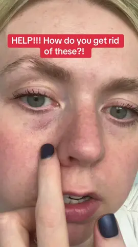 Please help! If you have ever had this texture under your eyes and you made it less noticeable or got rid of it comply, please share your tips! #undereyetreatment #skincaretips #skincareproducts #skincarehacks 