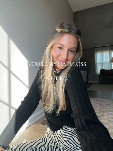 I often reminisce about my hair at its healthiest. Here's a before and after showing the impact of #TelogenEffluvium. It's been a journey, but I'm hopeful for full recovery & regrowth. 🌟 Also, I have zero pics with my hair down for obvious reasons, so there’s a screenshot! #HairLoss #HairTransformation #HairLossJourney #HairRegrowth #ThinningHair #HealthyHairGoals #BeforeAndAfter