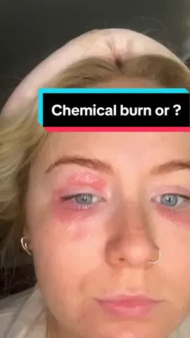 Bare in mine i didnt even apply it to my eyes. My wedding is less then a month too i could cry my face is so ugly and hurts @Garnier this product should not be on the market. Its literally burned my face 