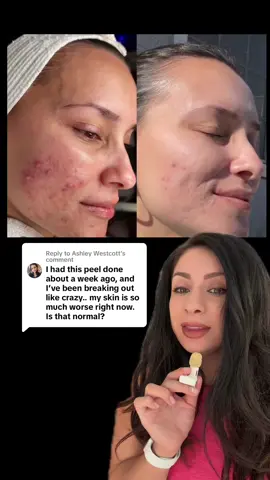 Replying to @Ashley Westcott Trust the process! It gets worse before It gets better 🥰🩵 #theperfectdermapeel #peel #acne #skin #glutathione #glycolicacid #skincare #medicalgrade #chemicalpeel #greenscreen 