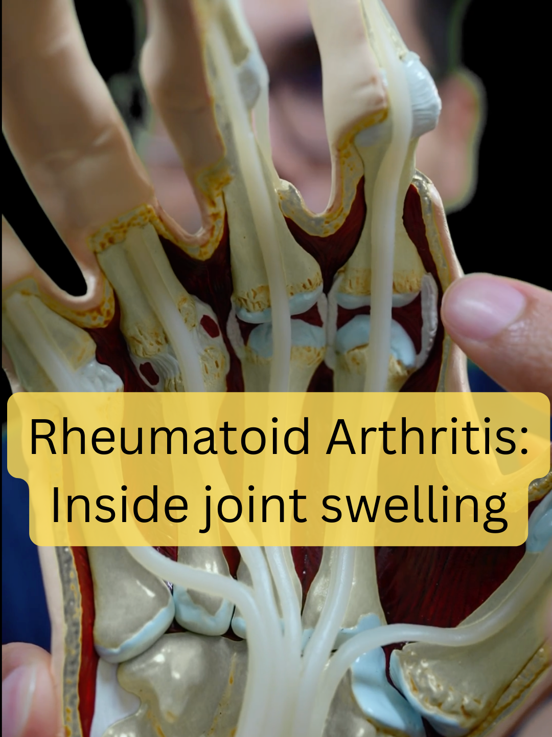 Inside hand swelling. . . . #rheumatoidarthritis #arthritis #inflammation#hand #swelling #jointpain #rheumatology #medicalstudent #doctorsoftiktok