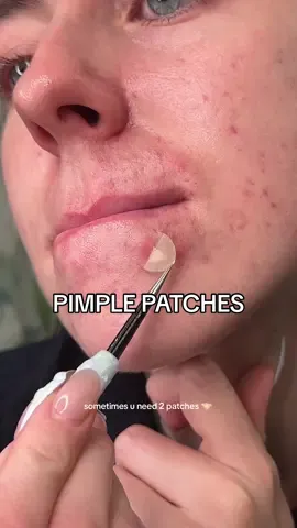 2 patches and some cicaplast baume does the trick 🪄 @Hero Cosmetics @La Roche-Posay #pimplepatches #pimplepatchpeel 
