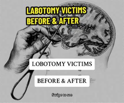 Lobotomy Victims Before & After… #lobotomy #labotomyvictim #beforeandafter #history 