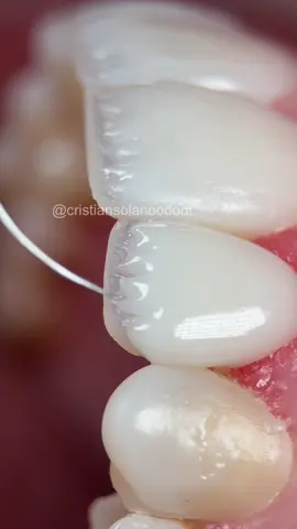 Ｃａｒｉｌｌａｓ    ｅｎ    Ｒｅｓｉｎａ  💎 Cada detalle cuenta 🖌️👌🏽 Técnica directa estratificadas ,todas las carillas son personalizadas, según la necesidad y gusto de cada paciente. Son delgadas capas de resina compuestas, que se moldean sobre el diente, cambiando la forma, tamaño y color, imitando la naturaleza del diente. 📍Ibagué y Bogotá 🇨🇴 Si quieres ver más casos como este y tener mayor información, visita nuestro perfil de Instagram👆🏽 👆🏽 #carillasenresina #lentesceramicos #diseñodesonrisanatural #diseñodesonrisacolombia #diseñodesonrisaibague #diseñodesonrisabogota #diseñodesonrisa #veneers  #porcelainveneers #veneerscolombia #odontologiaestetica #odontologiabogota #odontoligiaibague