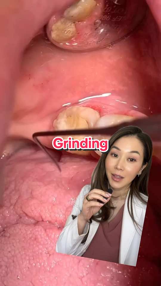 Dentistry Explained Episode 474738 | Teeth grinding can put a lot of extra force on the teeth. When there are large dental restorations, the teeth have a higher chance of breaking. This is why a crown or onlay would be recommended. #dentist #crown #teethgrinding #grinding 