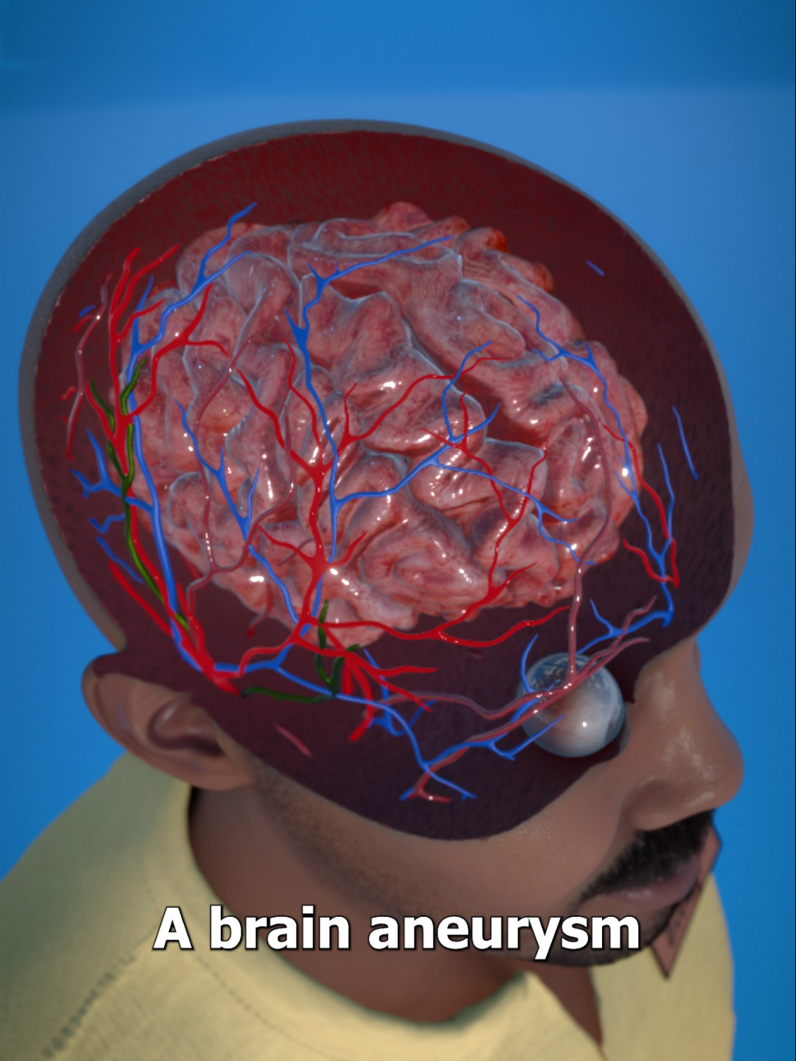 How A Brain Aneurysm Happens 🤔