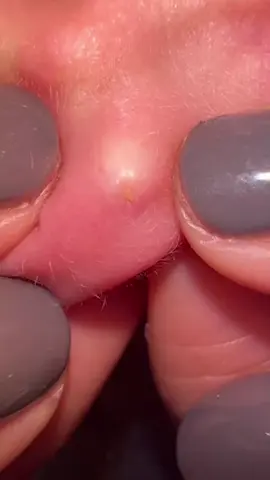 Satisfying Pimple Pops #Pimple#Zit #AcneRemoval #satisfyingvideo #popping #fyp