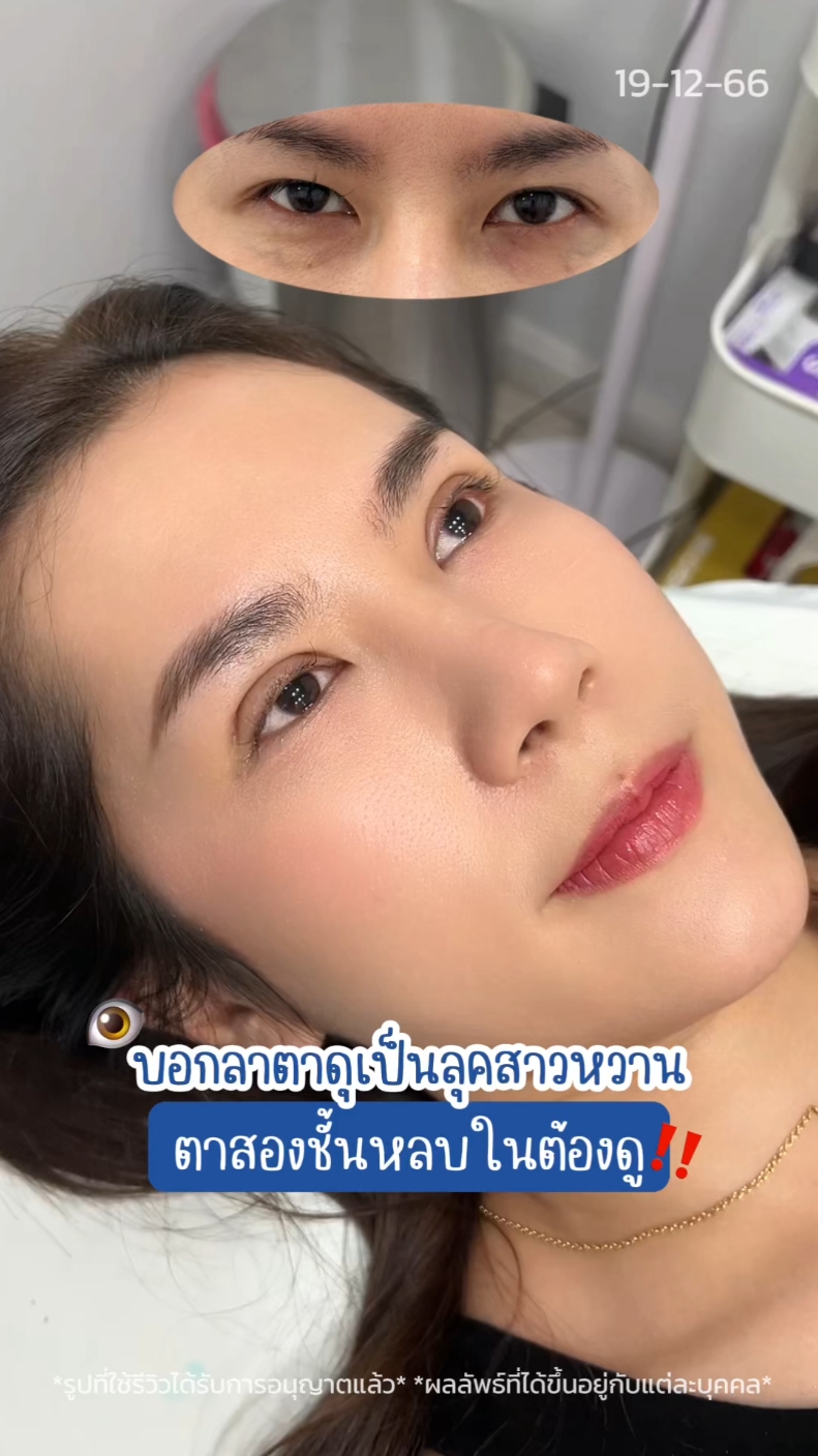 #รีวิวตาสองชั้น #skyclinic #หมอสกาย #สกายคลินิก #ศัลยกรรมตา #ทําตาสองชั้น #รีวิวตาสองชั้นskyclinic #sweeteyes #ทําตาที่ไหนดี #ตาสองชั้น #รีวิวศัลยกรรม 