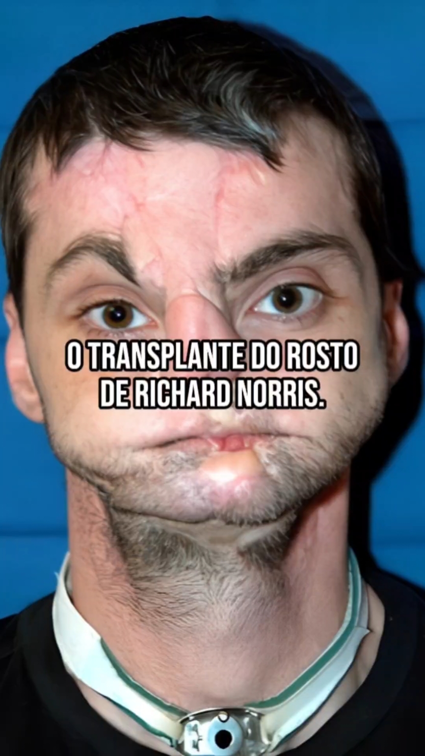 Richard Norris e seu Transplante de Rosto. #historias #fatosreais #fatoscuriosos #historiasemfotos #curiosidades #historiasreais #superação 