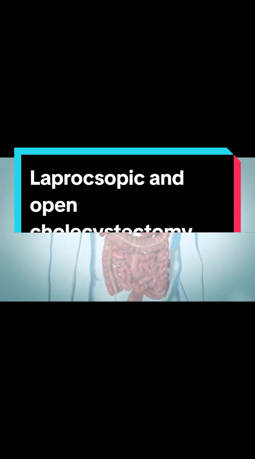 Laprocsopic and open cholecystectomy surgery (animation) 🥺 😢 #drnasrullah #foryoupage #foryou #100k #500k #1million #10kfollowers😭😭😭😭 #Love #viwesproblem #musica #unfrezzmyaccount #tiktok #viral #my #video #pypシ #pyfツ #fyp #pyf 