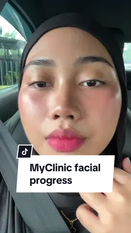 I buat facial kat Myclinic on 16/7. I recorded my progress everyday for a week. (17/7- 22/7). 🩷 #fypシ #myclinic #facial 