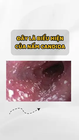 Chị em đang có biêir hiện như thế này nên lưu ý #khihu #phukhoa #namngua #namcandida #vesinhcobe #vagiflux #phunuhienđai 