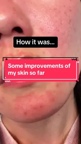 Like many people, I’ve had lots of skin issues to overcome. Ironically, people around me (close friends and family) non of them share the same headache as I do. It does make this skincare journey seem extea lonely. Although theres still a lot of work to be done, but im proud of myself and my skin to have made such improvements without any laser or small cosmetic surgeries.  I guess whatever ive been doing really works, and will keep it up and check back in in a few months. #skincare #skincarejourney #skinjourney #vlogger 