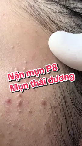 Nặn case mụn sướng cả tay luôn quý khách ạ 😁 #mun #nanmun #nanmunchuanykhoa #nanmunsinhvien #nanmungiare #nanmunhanoi #nanmunthanhxuan #trimun #dieutrida #phunglananh #trimunkhoahoc #trimuntritham #xuhuong #acne #acnetreatment #acneskin #hottrend #trend #mụn_nám_rỗ_tàn_nhang #trending  #thinhhanh 
