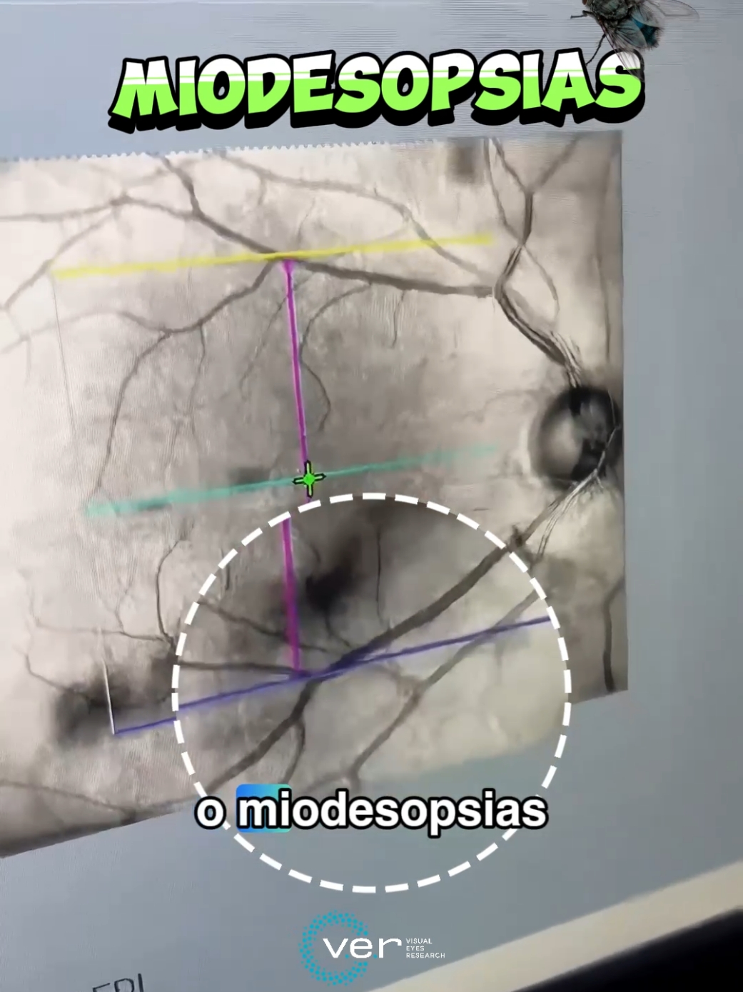 Un aumento de #miodesopsias repentino puede indicar problemas oculares #oftalmologia #peru 