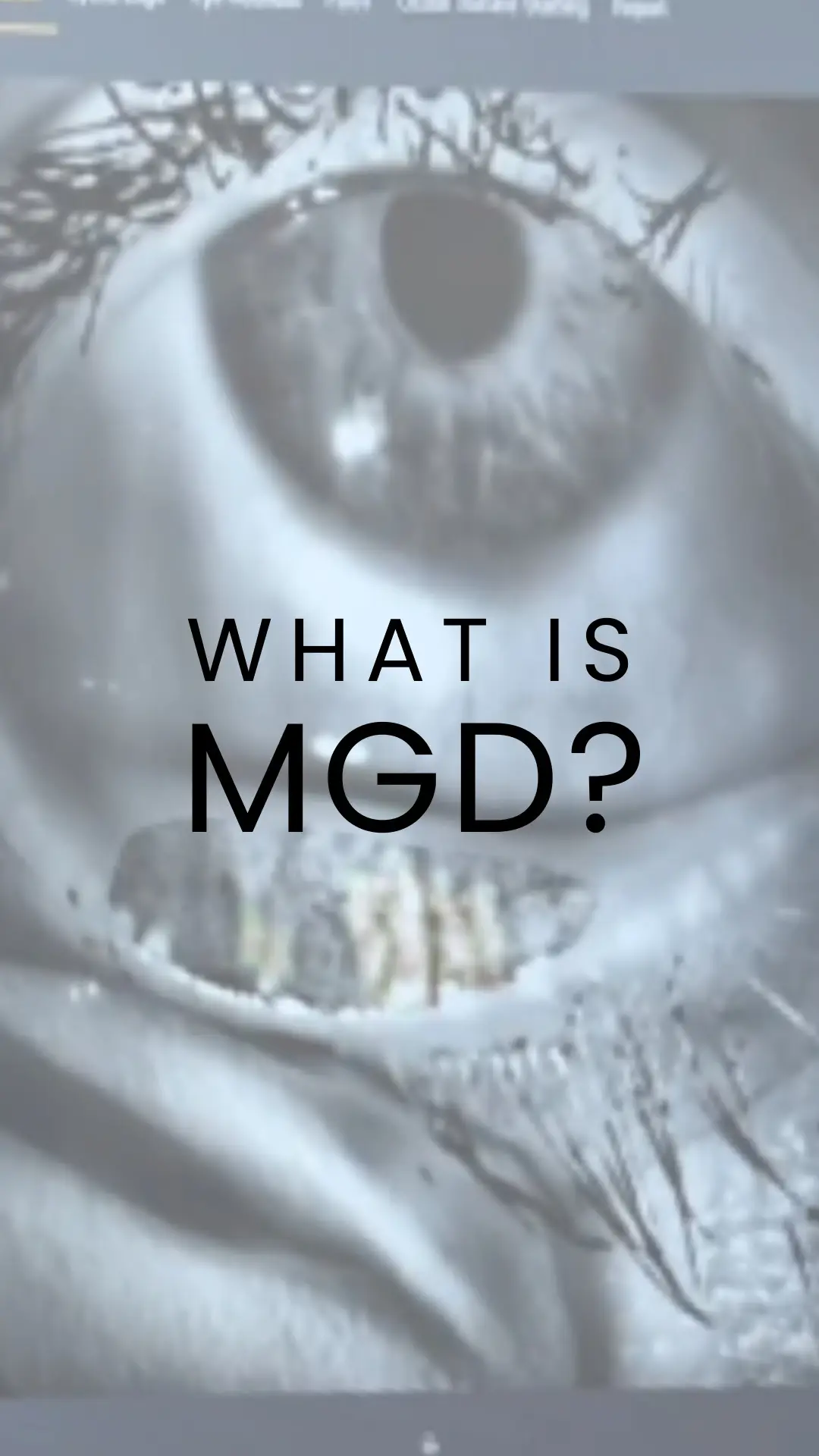 Meibomian Gland Dysfunction (MGD) is a common eye condition where the oil-producing glands in your eyelids become blocked or inflamed. This leads to thickened oils and reduced oil production, causing instability in the tear film. As a result, tears evaporate too quickly, leading to dry eye symptoms like irritation, redness, sandpaper-like feeling in your eye, and blurred vision. Common causes include hormonal changes, aging, chronic eyelid inflammation, and skin conditions like rosacea. Prolonged screen time and contact lens use can also worsen MGD. We treat MGD with advanced technologies like Forma-i and Lumecca-i. Forma-i uses radiofrequency to stimulate and unclog the meibomian glands, improving oil flow and reducing inflammation. Lumecca-i, an intense pulsed light (IPL) therapy, targets blood vessels and reduces chronic eyelid inflammation, enhancing gland function. Alongside these treatments, warm compresses, eyelid hygiene, and prescription eye drops are also recommended. Early detection and treatment are key to maintaining eye comfort and health. #IslandEyecare #DrAnitaNarang #DryEyeAwareness #InMode #DryEyeSolutions #MGD #VictoriaBC #EyeClinic