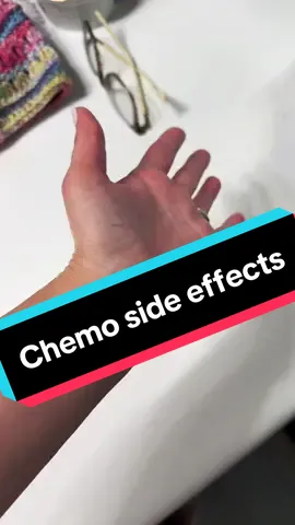 Odd side effect of chemo. I believe this is varicose veins in my palm ✋. ##chemotherapy##chemo##chemotherapysideeffects##veins##cancer##cancersucks##cancerthriver##cancerfighter##lymphoma##reddevil